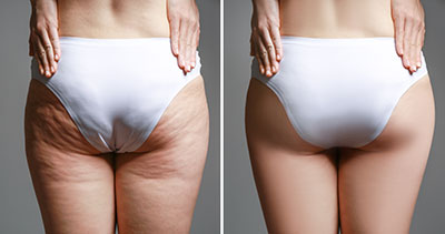 Po mit Cellulite; Vorher-Nachher-Bild Voher-Nacher-Bild; Po einer Frau in weißer Unterhose. Voher: Massive Cellulite am Po und im Bereich unter dem Po. Nachher-Bild: Die Haut ist wieder schön, glatt und prall. Africa Studio/Shutterstock.com